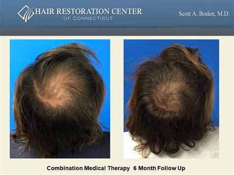precision medical hair restoration|Hair Loss Treatment Options .